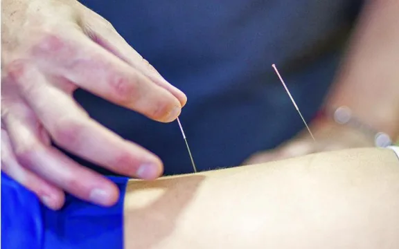 Acupuncture needles being placed in a client's shoulder